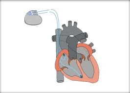 Therapie mit Herzschrittmachern in Berlin mit Nachsorge